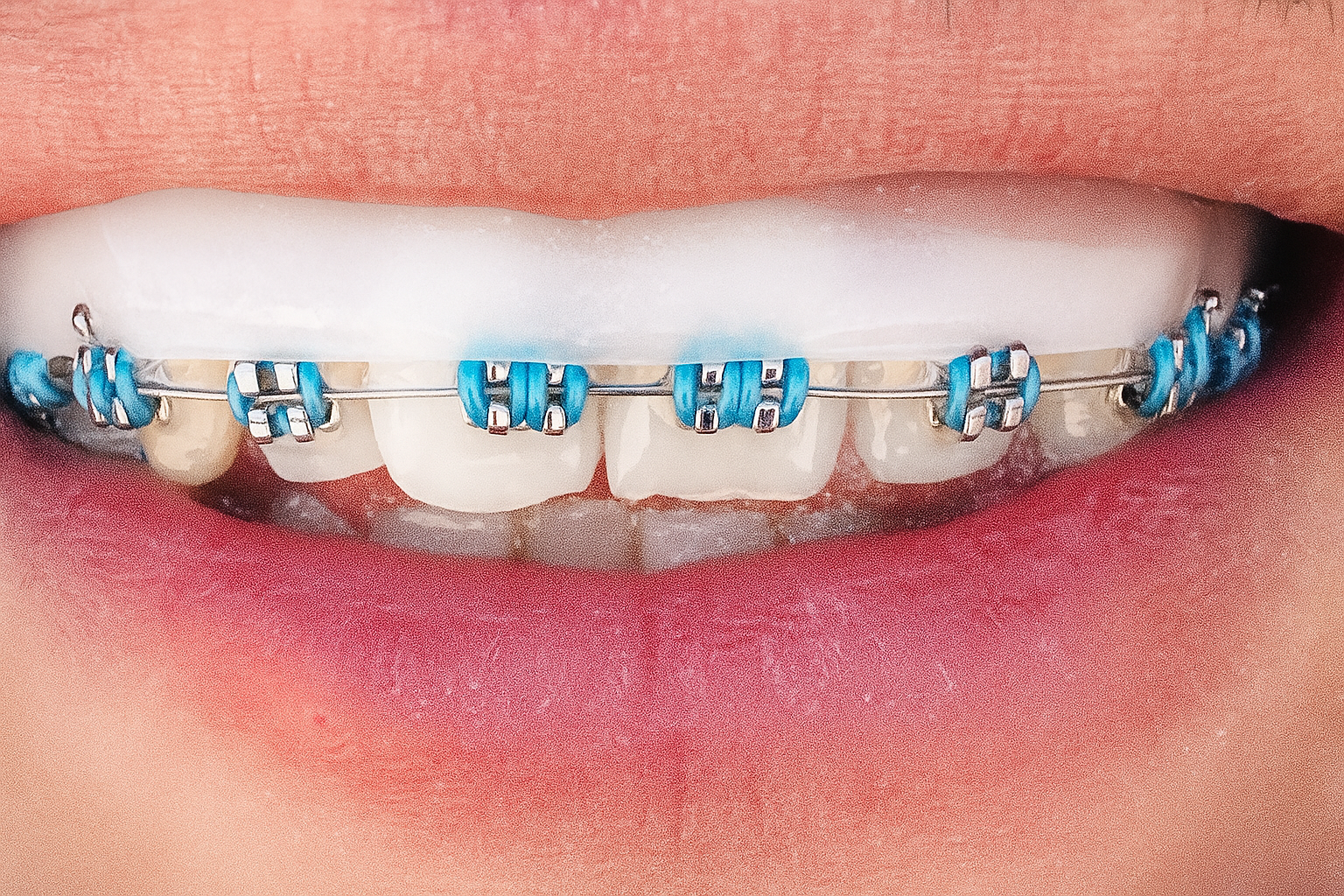 SoftBrace Usage Application